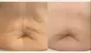 Up to 80% Off on Ultrasonic Fat Reduction at Renew Contouring