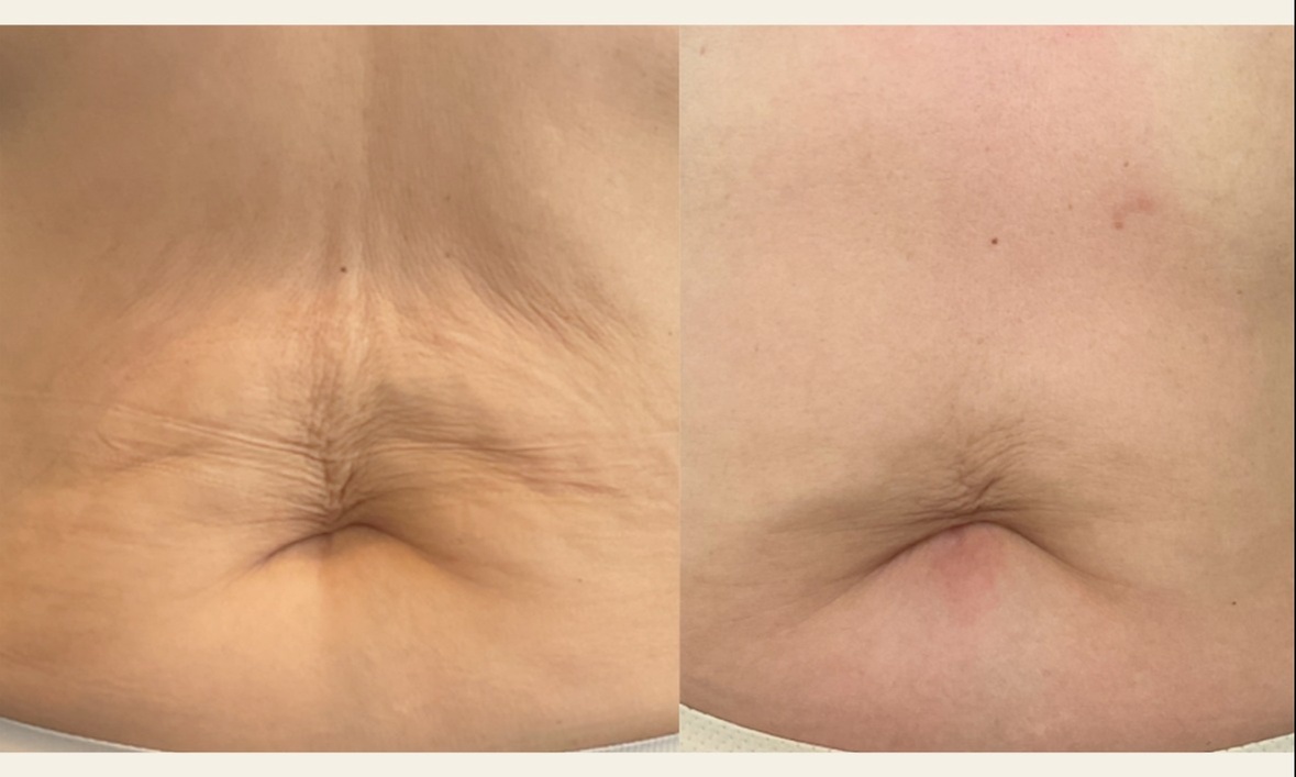 Up to 82% Off on Ultrasonic Fat Reduction at Renew Contouring