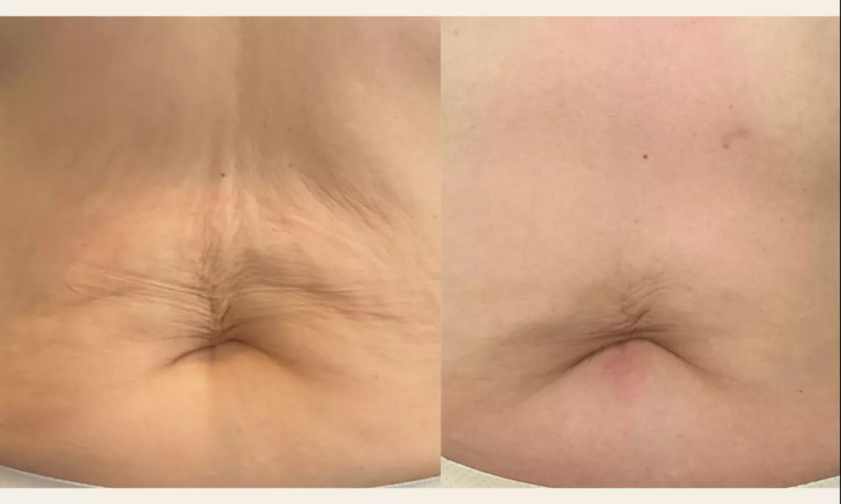 Up to 80% Off on Ultrasonic Fat Reduction at Renew Contouring