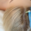 Image 3: 30 Min. PRP-Behandlung für Kopfhaut zur Anregung des Haarwachstums
