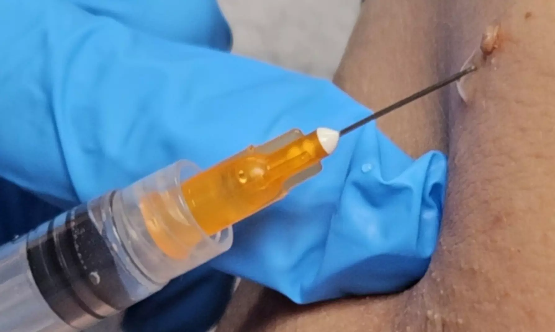 Achieve Smooth Skin with Med Therapy and Spa's Efficient Tag Removal up to 42%