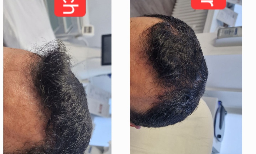 Image 5: Bis zu 5% Rabatt auf den Facial - Eigenblut bei PRIVATPRAXIS Nataliya Katsarova