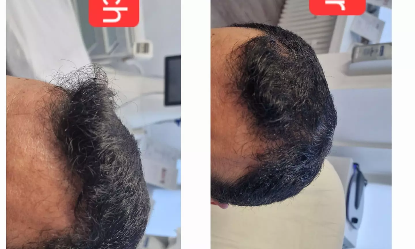 Bis zu 5% Rabatt auf den Facial - Eigenblut bei PRIVATPRAXIS Nataliya Katsarova