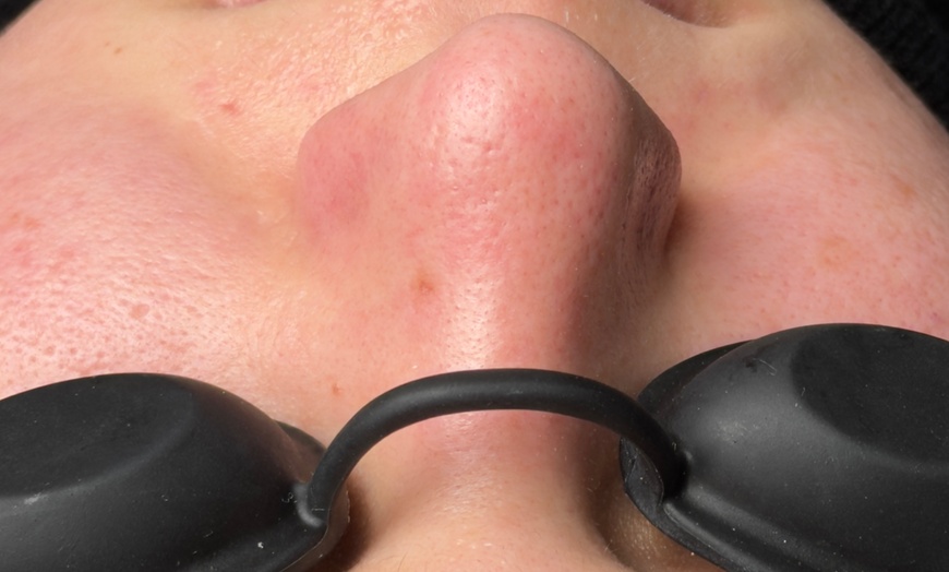 Image 4: Luxury Exosome Mesotherapy with PDRN for Skin Repair & Radiance
