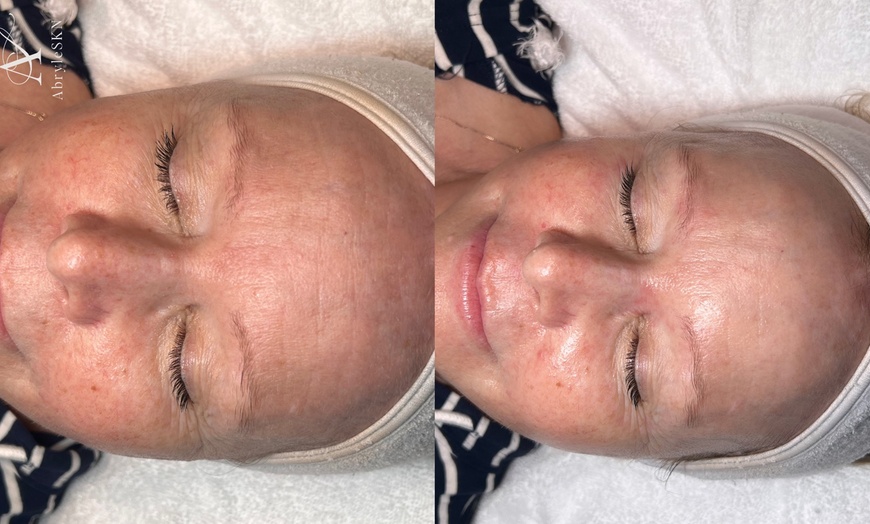 Image 3: Up to 30% Off on Facelift - Non-Surgical at AbryleSKN
