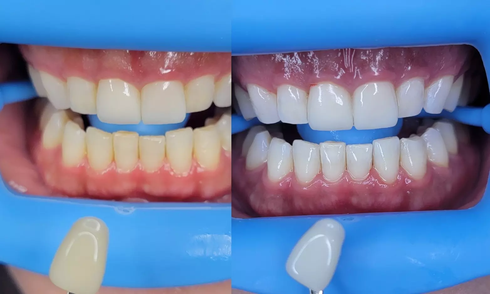 Up to 51% Off on Teeth Whitening at Vs Aesthetics