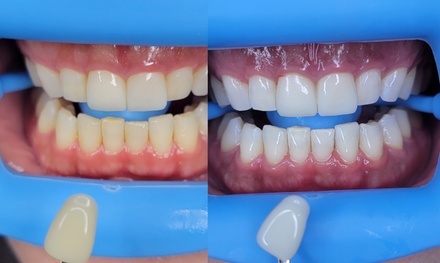 One 30 Minute Teeth Whitening Treatment - VS Aesthetics