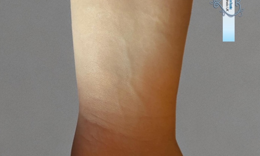 Image 2: Up to 60% Off on Tattoo Removal at Skintastic Aesthetics Treatments