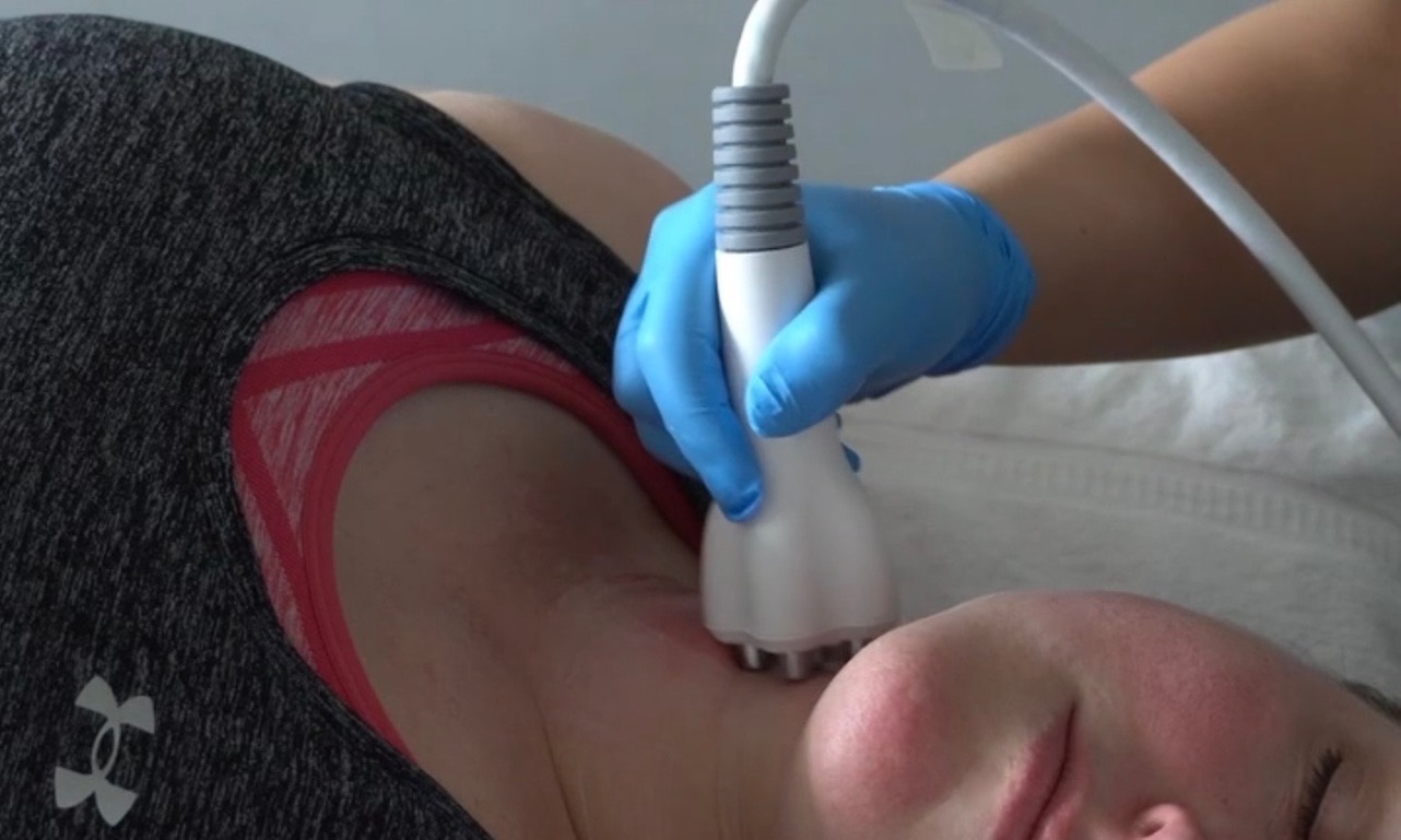 RF Skin Tightening Treatment for Face w/ or w/o Neck