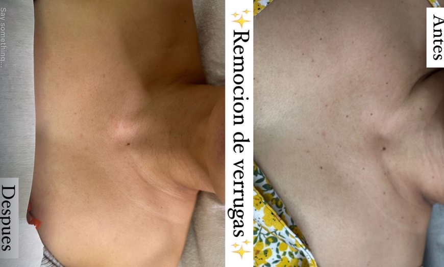 Image 3: Remove Up To 10 Skin Tags, Moles, Warts Or Milia Up To 2mm