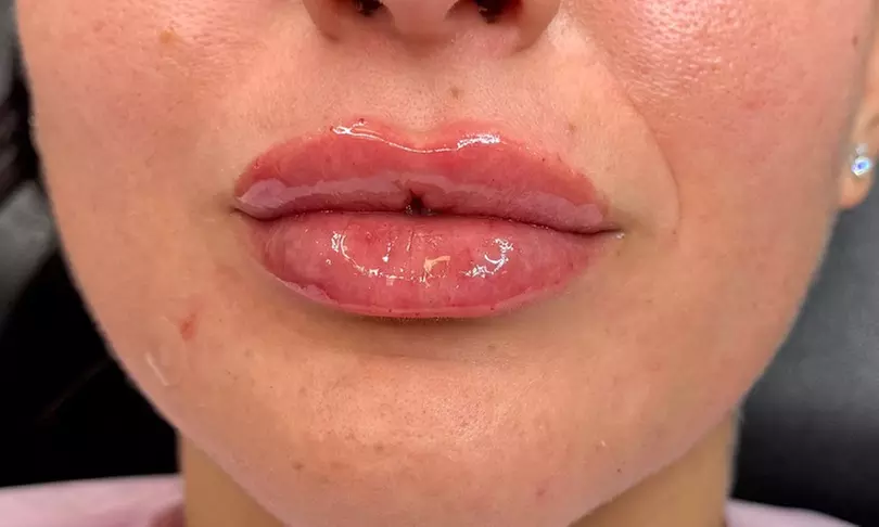 Up to 37% Off on Injection - Dermal Filler at Hilenda's Alluring Makeup - Primary Image