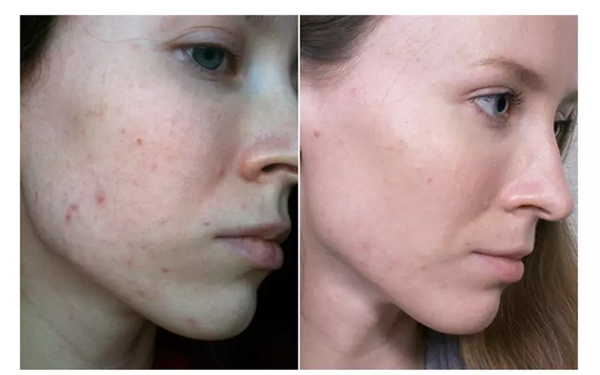 Say Goodbye to Acne: Plason Plasma Clear Acne Treatment Plan