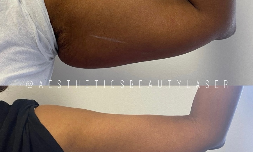 Image 3: Up to 82% Off on Lipo - Non-Invasive Laser-iLipo at Aesthetics Beauty Laser