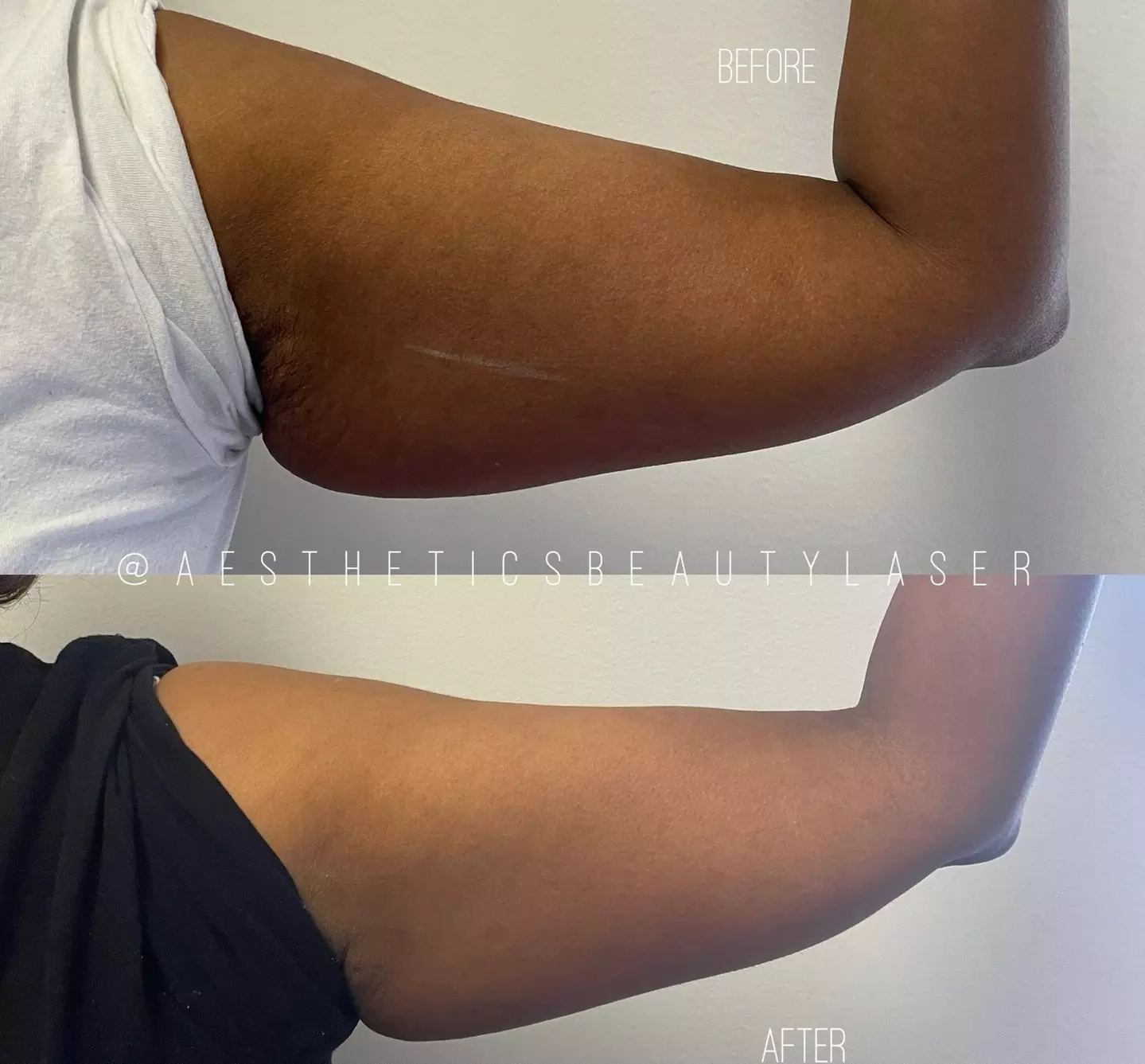 Up to 82% Off on Lipo - Non-Invasive Laser-iLipo at Aesthetics Beauty Laser