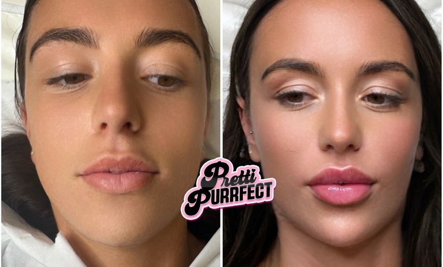 Image 5: Up to 68% Off on Injection - Dermal Filler at Pretti Purrfect