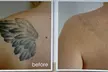 9-Session Laser Tattoo Removal for Areas Less than 1 in up to 88 Sq In at Naked Lasers - Up to 37% Off - Image 2