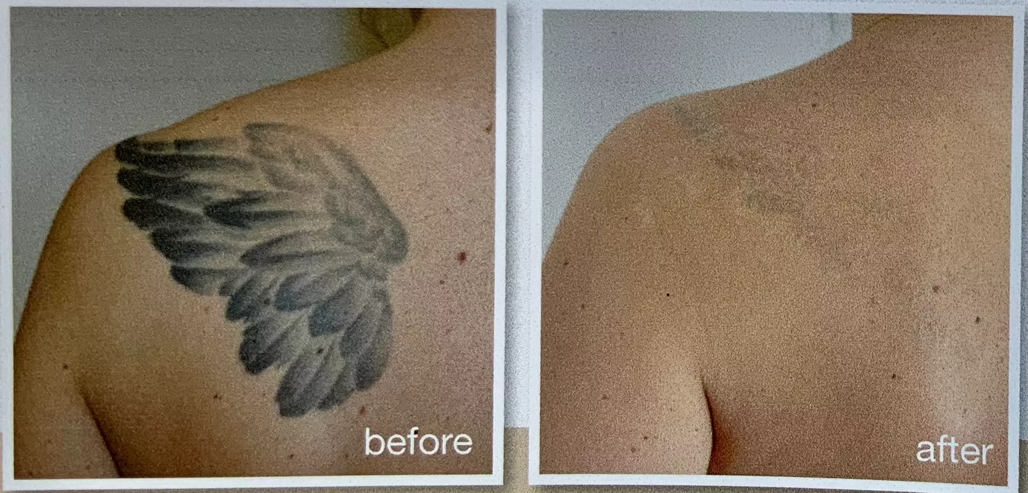 9-Session Laser Tattoo Removal for Areas Less than 1 in up to 88 Sq In