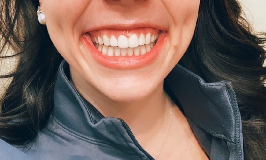 Image 4: Teeth Whitening Full Service Treatment 60-minute and More