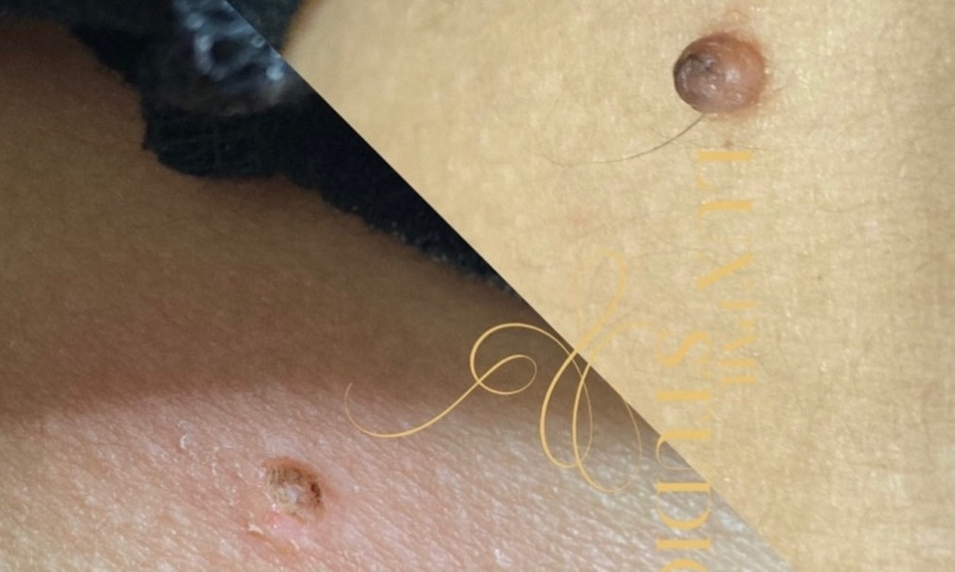 Up to 30% Off on Mole / Growth Removal at Lux Studio