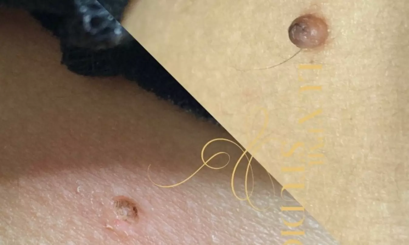 Up to 37% Off on Mole / Growth Removal at Lux Studio - Primary Image