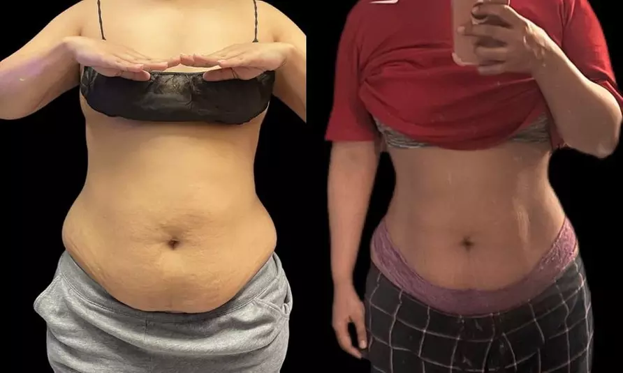 Revitalize with Fat Reduction with Skin Tightening Treatments