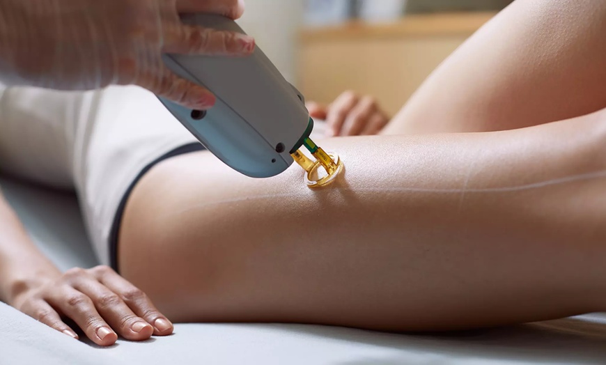 Image 1: Unlimited Laser Hair Removal Sessions For One Year
