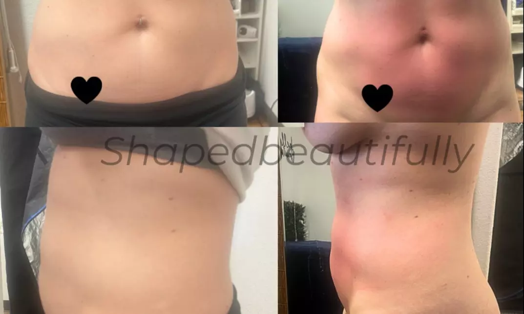 Up to 56% Off on Lymphatic Drainage Massage at Shaped Beautifully