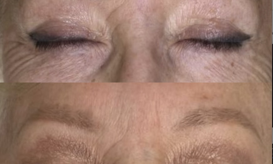 Image 2: Experience Laser By Nicole - Fort Lauderdale with three tattoo removal treatments for various area sizes up to 37% off