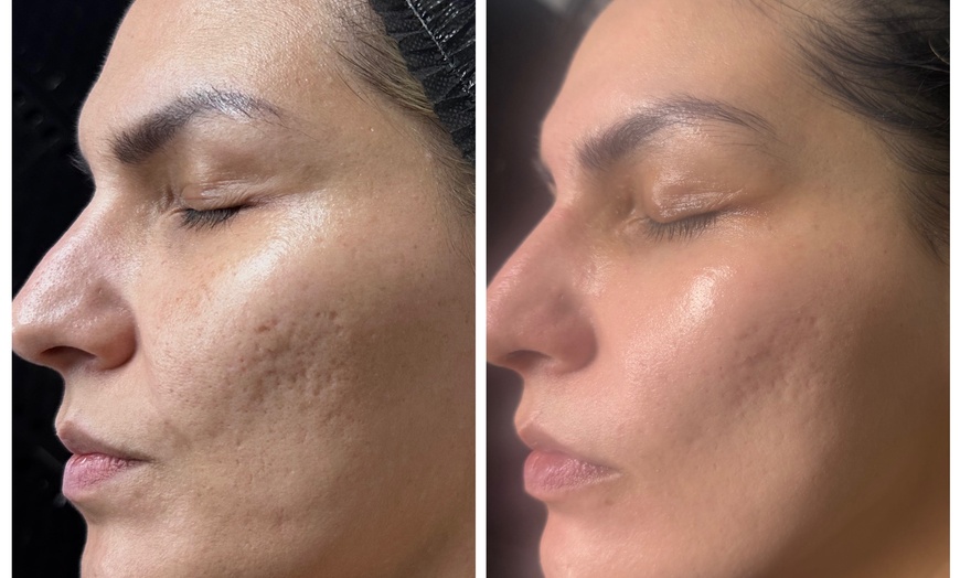 Image 2: Gift Card Toward 60-Min Service or TCA Cross for Skin Scars