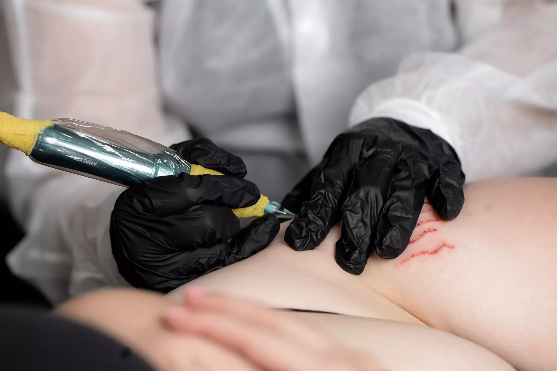 Transform Your Skin with Targeted Stretch Mark Revision or Removal
