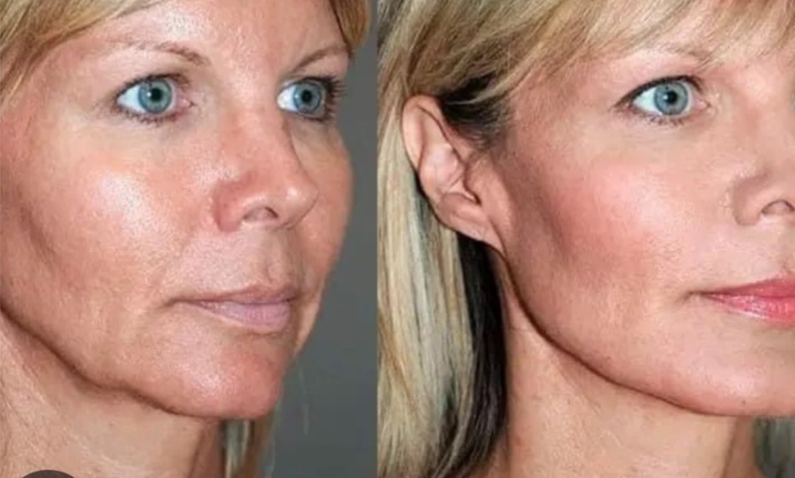 Image 1: Transform Your Look Instantly with a Non-Surgical Facelift Magic!