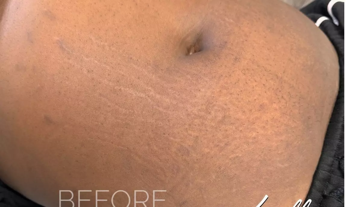 Discover Addictive Beauty Brows's Inkless Stretchmark Rejuvenation(UP to 30% Off) - Primary Image