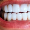 Image 1: Teeth Whitening Branded at Your Covina Family Dentistry