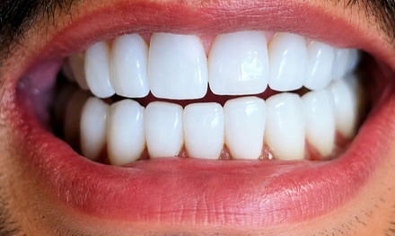 One Beyond Whitening Session - Your Covina Family Dentistry