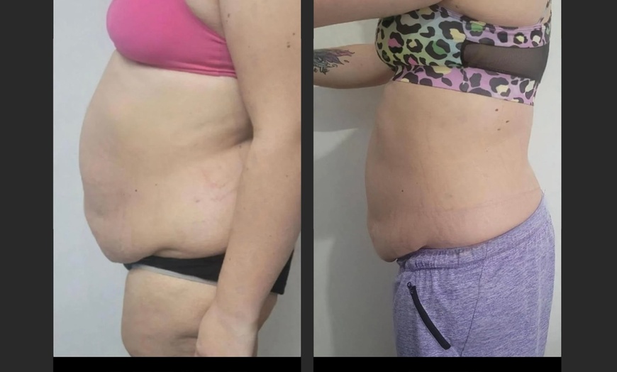 Image 3: One 30-Min EMS Body Contouring session on the Abdomen or on the Glute