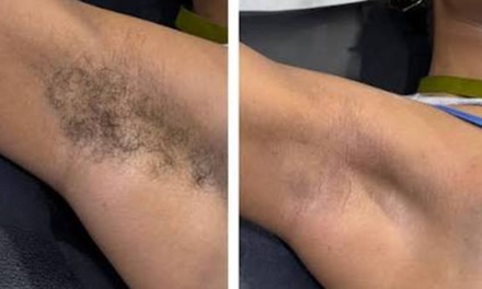 One Underarm Sugaring - skincode