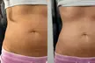 Get 1 or 2 Body Sculpting, Cellulite Reduction & Lymphatic Drainage Massage @ Evolutionary Skin(Up To 60% Off) - Second Medium