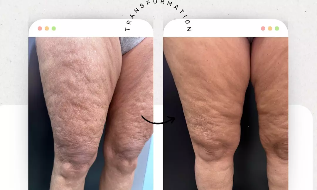 Up to 58% Off Radio Frequency Skin Tightening at The Body Lux