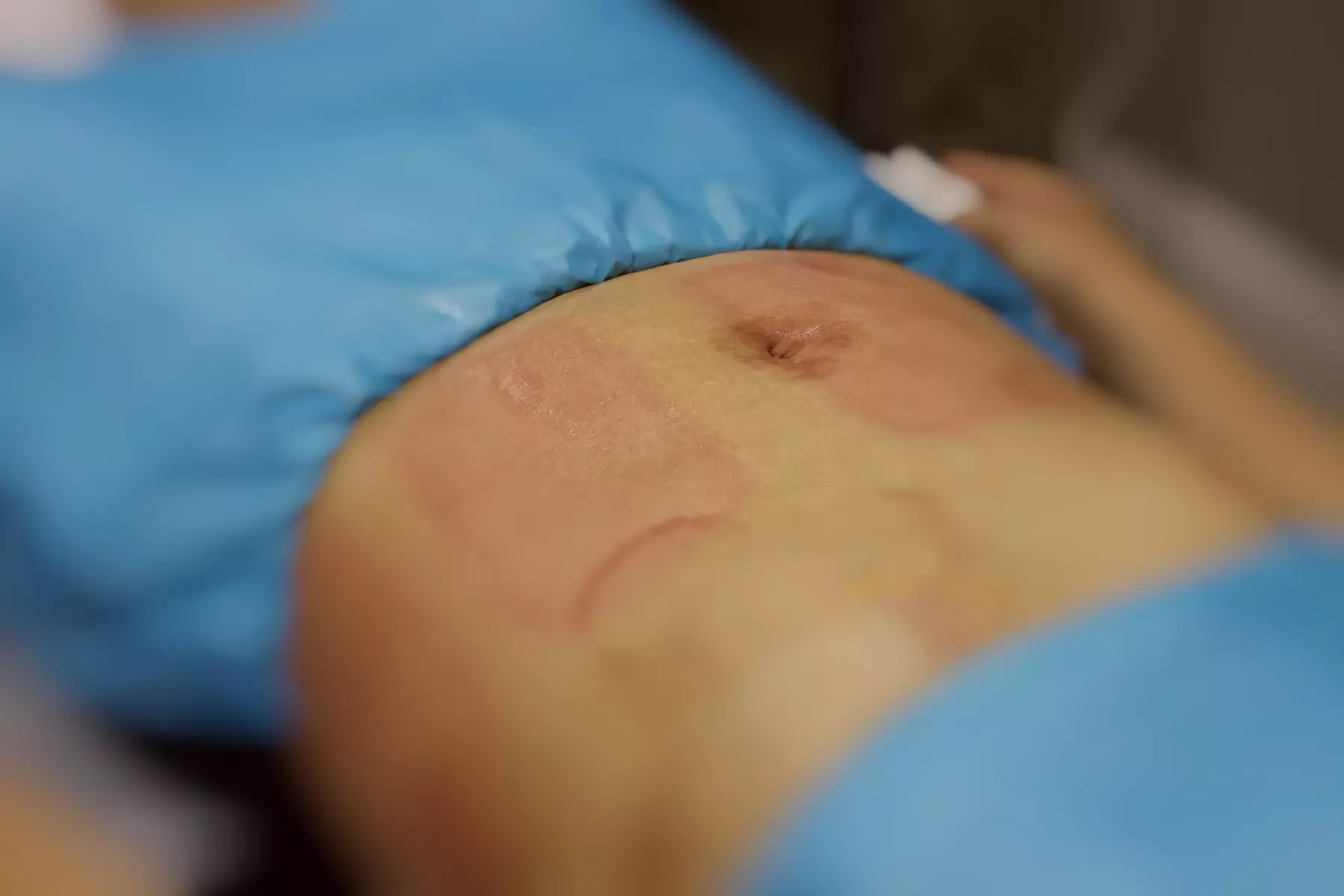 Rejuvenate Your Body: Cryotherapy, Acupuncture and More