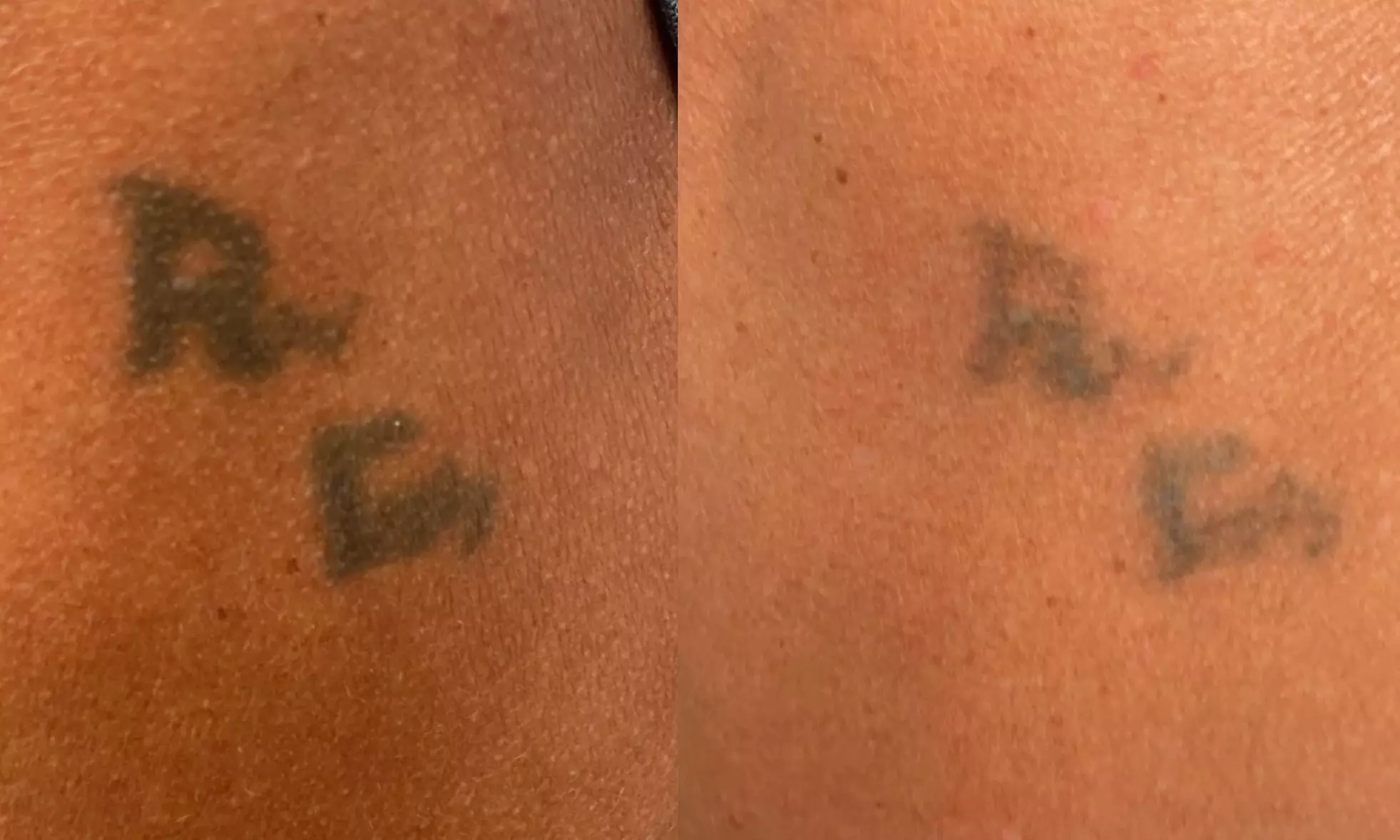 Experience Laser By Nicole - Fort Lauderdale with three tattoo removal treatments for various area sizes up to 37% off