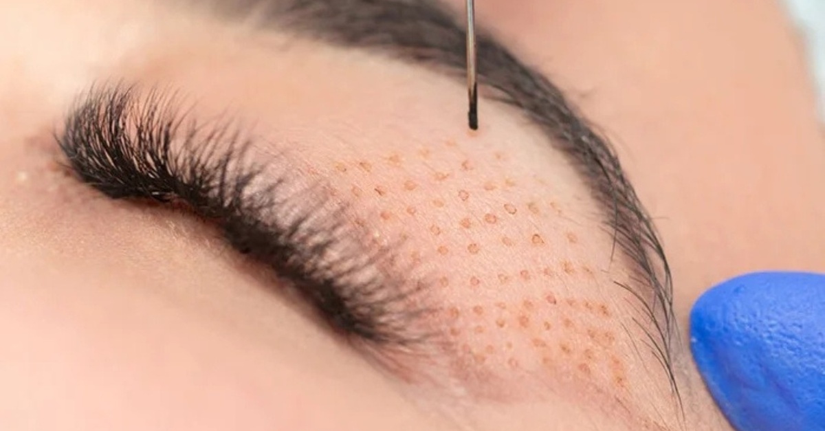 Tratamiento facial de ojeras y párpados con Plasma Pen en Valencia