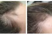 Scalp Micropigmentation Hair-Loss Treatment - Crown, Front, or Filler (Density Effect) - Women/Men(Up to 44%Off) - Second Medium