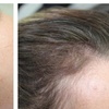 Image 3: Scalp Micropigmentation Hair-Loss Treatment - Crown, Front, or Filler