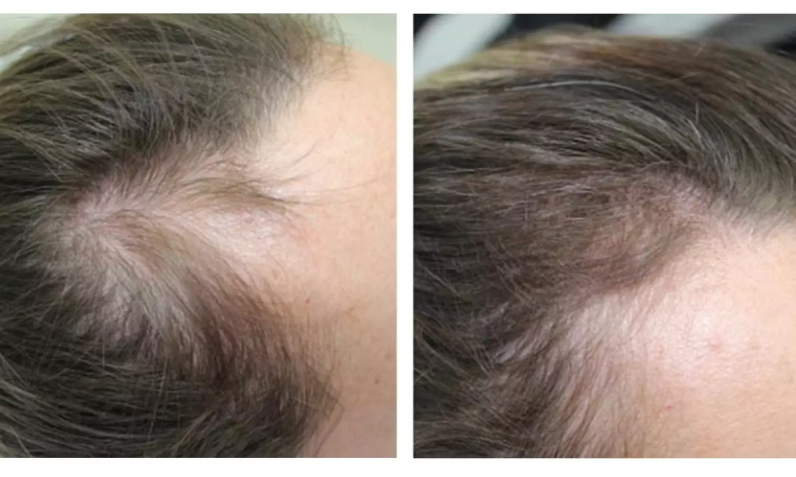 Scalp Micropigmentation Hair-Loss Treatment - Crown, Front, or Filler