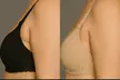 Enhance Your Look with One or Two Vials of Kybella at Clinical Care 365 (Up to 58% Off) - Second Medium
