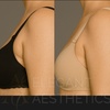 Image 4: Melt Stubborn fat with One or Two Vials of Kybella @ Clinical Care 365