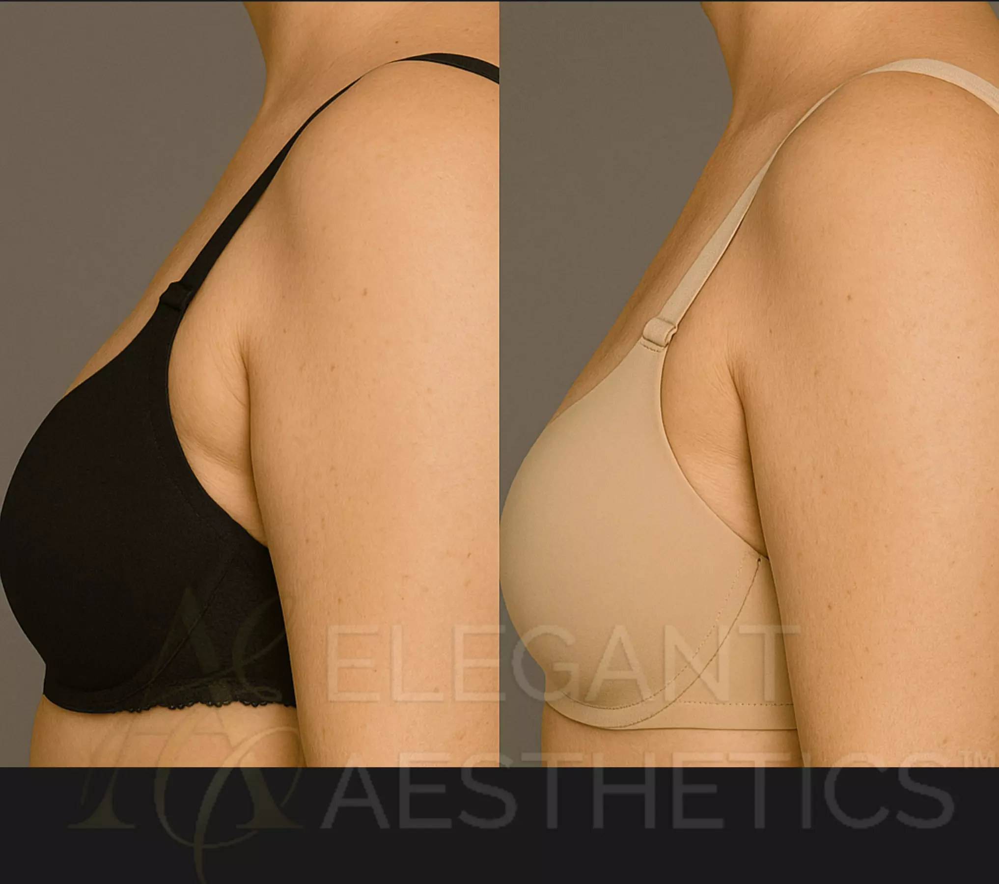 Enhance Your Look with One or Two Vials of Kybella