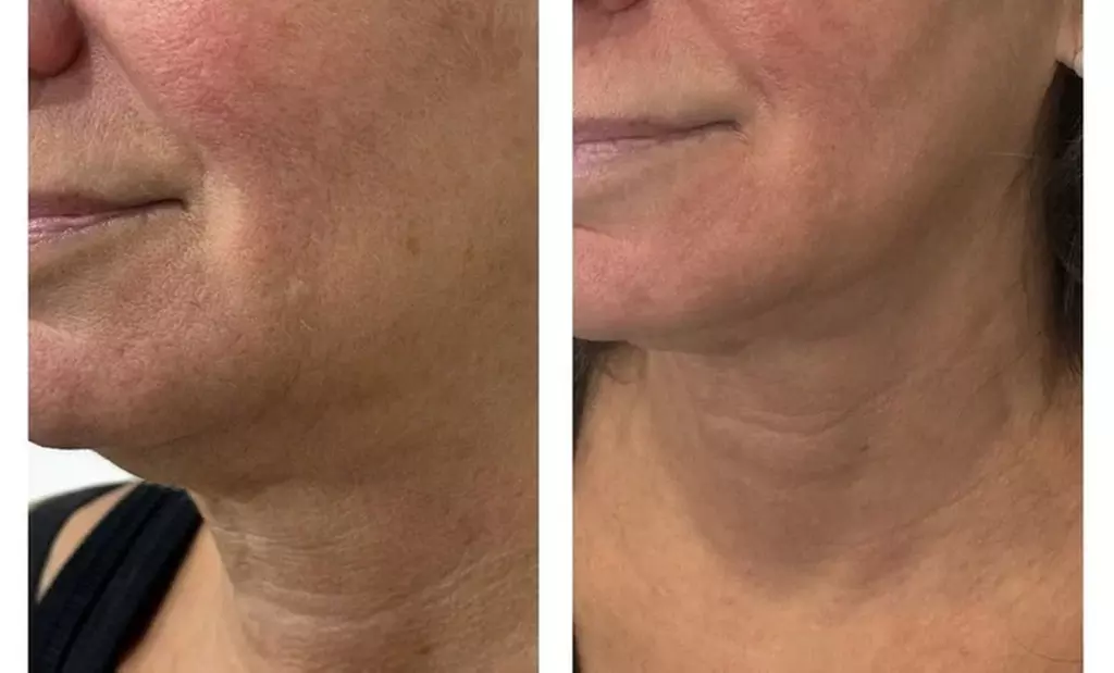 Revitalize Your Skin with 30 or 60-Minute Chemical Peels