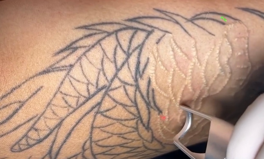 Image 1: Up to 66% Off on Pico Laser Tattoo Removal at bc clinic
