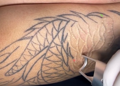 Pico Laser Tattoo Removal (1 cm - 3 cm) - bc clinic